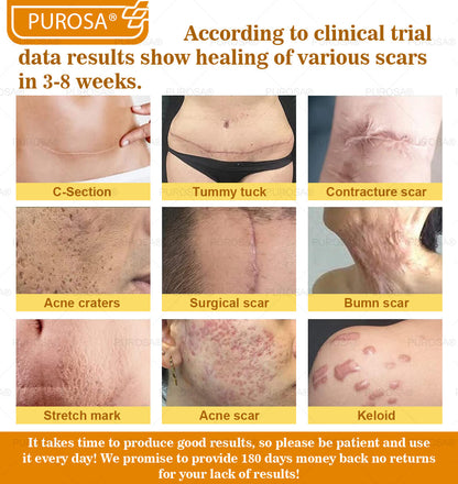 Limited to 10 jars! 🌟PUROSA®—Exclusive 30% discount, restore your skin's youthful glow in just 1-3 weeks! A rare opportunity — won’t be available again until next year, don’t miss out!180-day money-back guarantee, full refund with no risk!