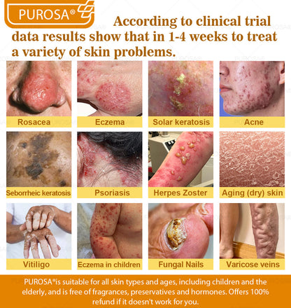 Limited to 10 jars! 🌟PUROSA®—Exclusive 30% discount, restore your skin's youthful glow in just 1-3 weeks! A rare opportunity — won’t be available again until next year, don’t miss out!180-day money-back guarantee, full refund with no risk!